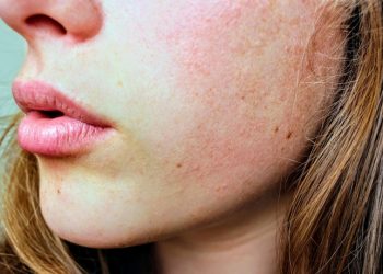 Beslenme eksikliği belirtileri kuru bir cildiniz varsa…