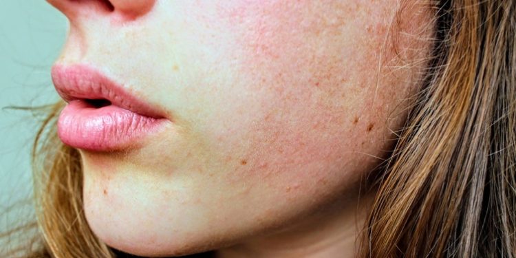 Beslenme eksikliği belirtileri kuru bir cildiniz varsa…