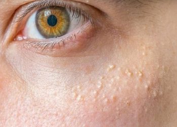 Yüzdeki beyaz noktalar neden olur makyaj kalıntıları sebebi!