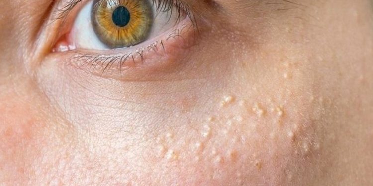 Yüzdeki beyaz noktalar neden olur makyaj kalıntıları sebebi!