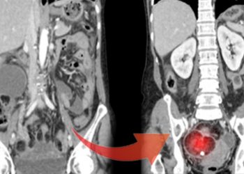 9 kiloluk tümörü görenler şaşkına döndü! Bilhassa genç bayanlarda çok yaygın…
