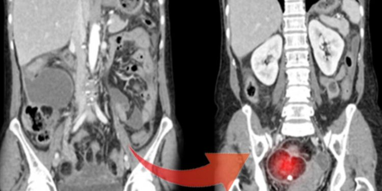 9 kiloluk tümörü görenler şaşkına döndü! Bilhassa genç bayanlarda çok yaygın…