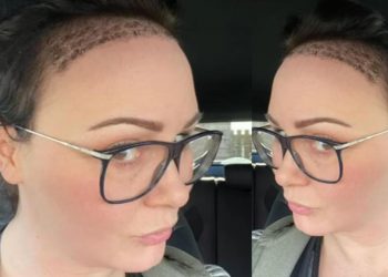 Kendimden nefret eder hale gelmiştim: Ünlü yıldız sekiz saatlik operasyonla saç ektirdi