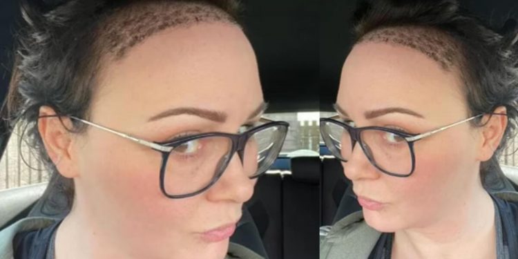 Kendimden nefret eder hale gelmiştim: Ünlü yıldız sekiz saatlik operasyonla saç ektirdi