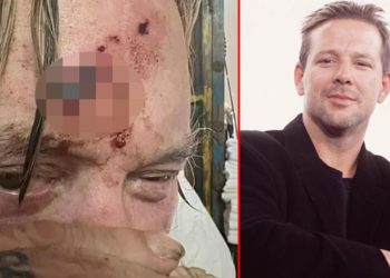 Eski günlerim geride kaldı: Ünlü oyuncudan ‘kan revan’ paylaşım… ‘Yüz sinirlerimi bozup attılar’ demişti