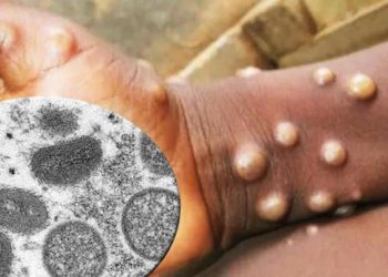 İngiltere duyurdu: Maymun çiçeği olayları yükselecek