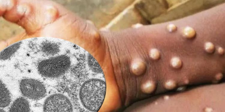 İngiltere duyurdu: Maymun çiçeği olayları yükselecek