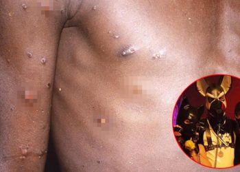 Maymun çiçeği paniği büyüyor: Hastalık ‘fetiş’ şenliğinden yayılmış!