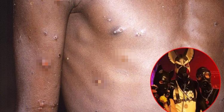 Maymun çiçeği paniği büyüyor: Hastalık ‘fetiş’ şenliğinden yayılmış!