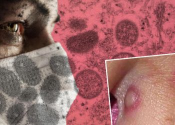 Son dakika: Maymun çiçeği virüsü bir ülkeye daha sıçradı… CDC’den flaş açıklama geldi!