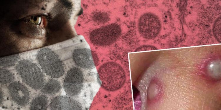 Son dakika: Maymun çiçeği virüsü bir ülkeye daha sıçradı… CDC’den flaş açıklama geldi!