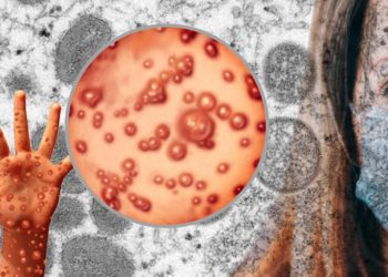 ABD’de Maymun çiçeği virüsü alarmı… CDC’den flaş açıklama geldi!