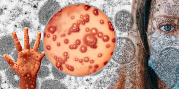 ABD’de Maymun çiçeği virüsü alarmı… CDC’den flaş açıklama geldi!