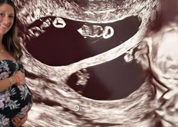 Ultrasona giren anne adayı hayatının şokunu yaşadı! 70 milyonda bir görülüyor…