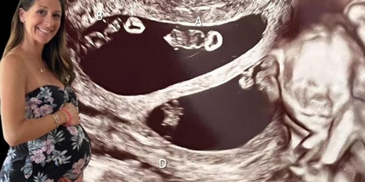 Ultrasona giren anne adayı hayatının şokunu yaşadı! 70 milyonda bir görülüyor…