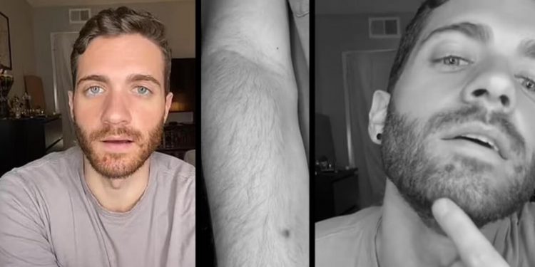 ABD’de bir birinci… Maymun Çiçeği hastalığına yakalanan aktör yaşadıklarını anlattı…